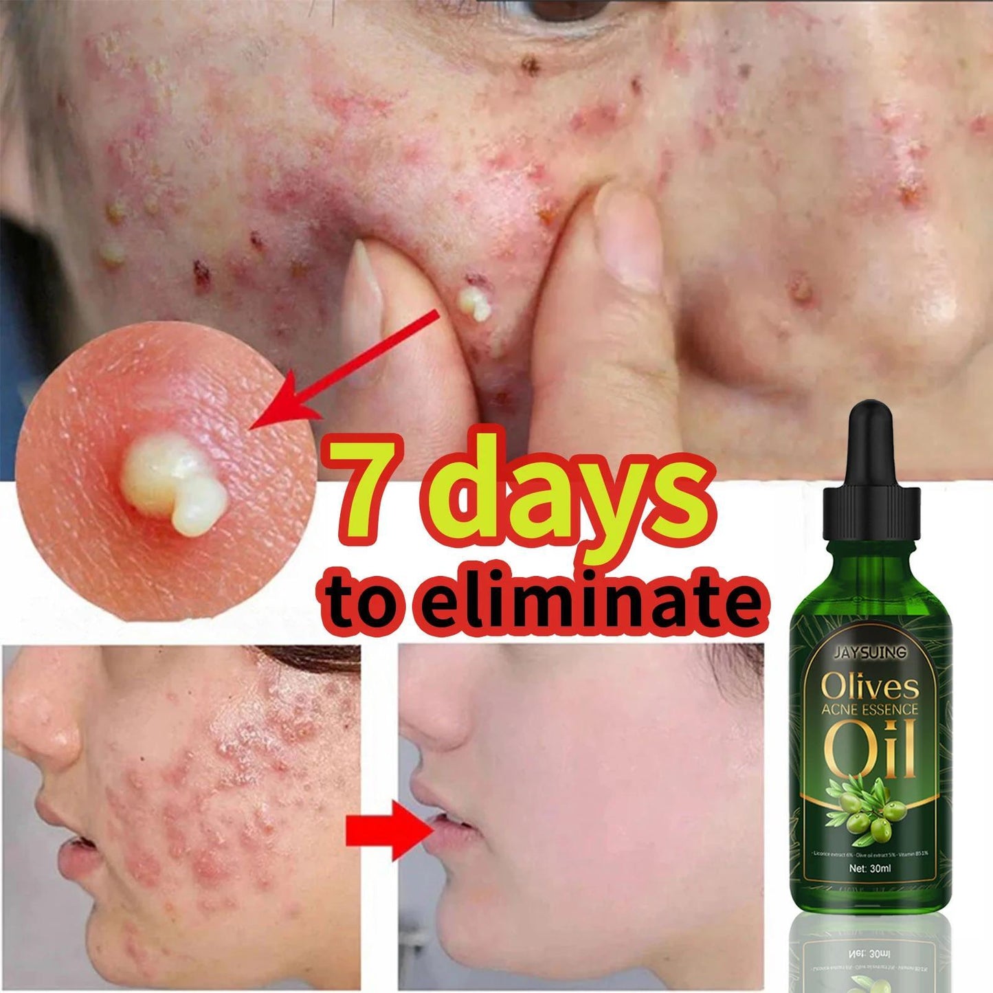 Acne Clarifying Oil – Gentle Repair & Moisturizing (30ml)”