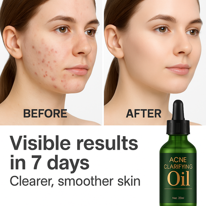 Acne Clarifying Oil – Gentle Repair & Moisturizing (30ml)”