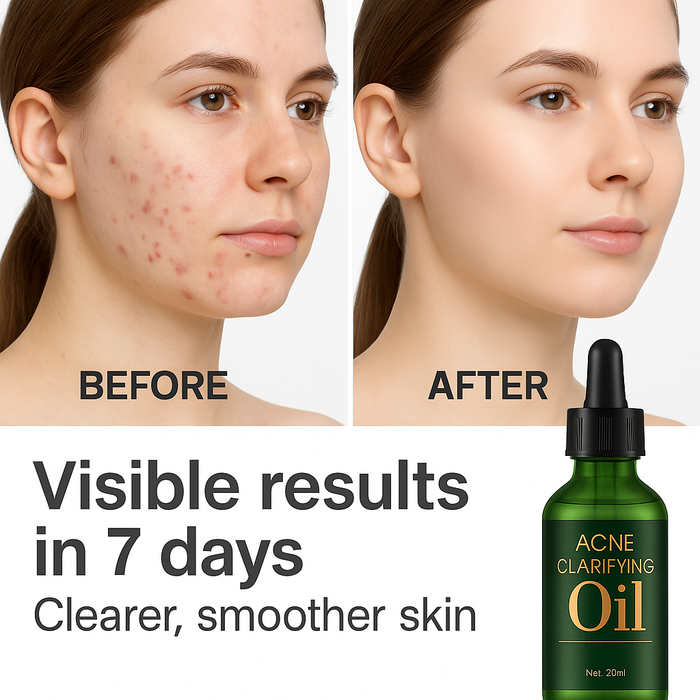 Acne Clarifying Oil – Gentle Repair & Moisturizing (30ml)”