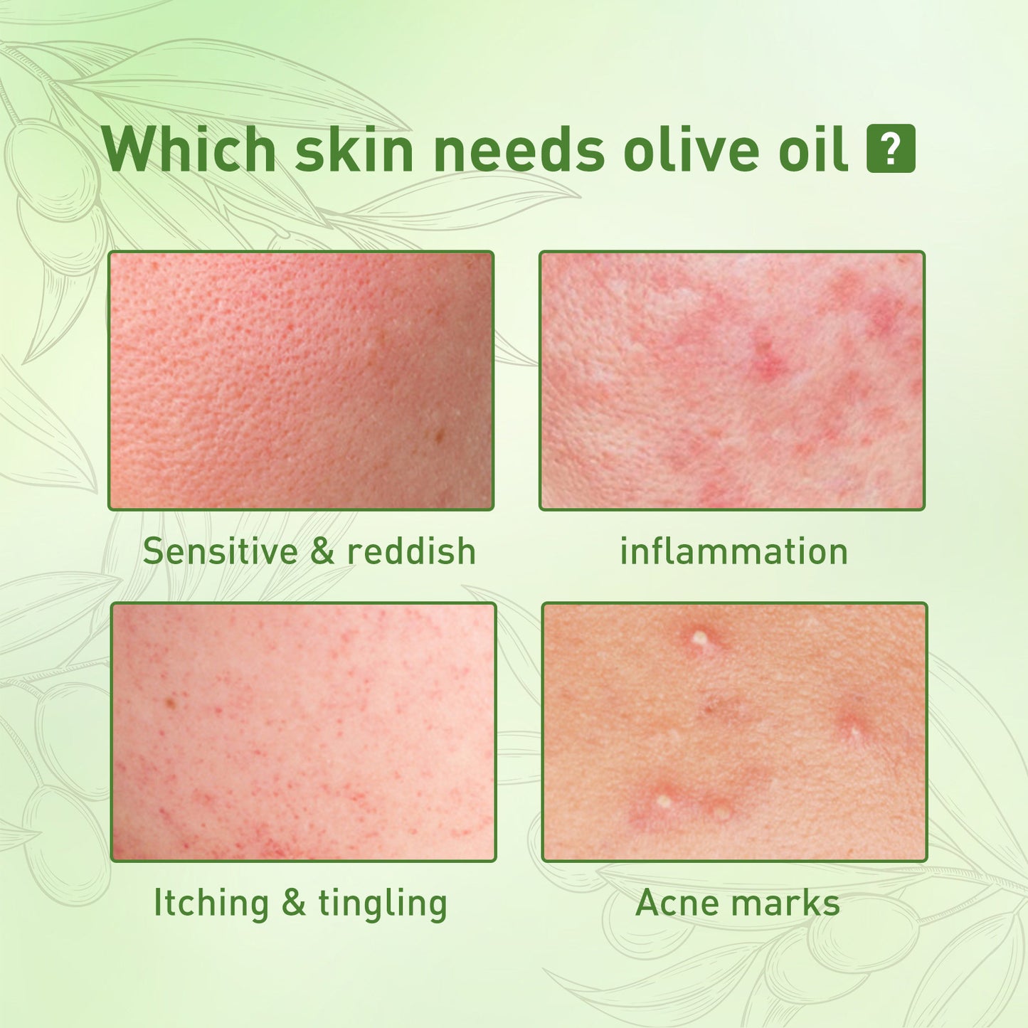 Acne Clarifying Oil – Gentle Repair & Moisturizing (30ml)”
