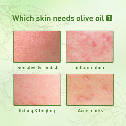 Acne Clarifying Oil – Gentle Repair & Moisturizing (30ml)”